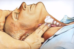 帶你了解心肺復(fù)蘇（<em>圖</em>1）