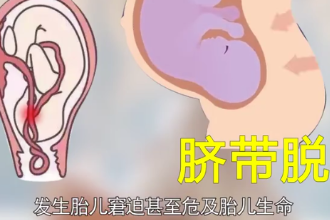 一<em>分鐘</em>了解<em>臍帶</em><em>脫</em><em>垂</em>